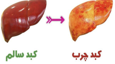 کبد چرب