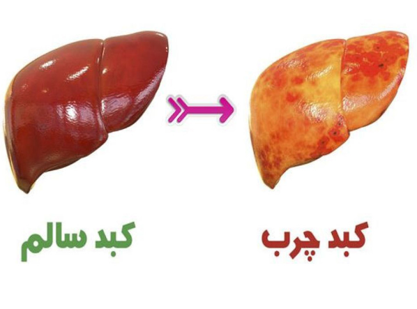کبد چرب