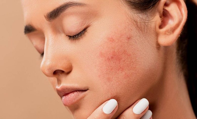 با کنار گذاشتن این عادتها، پوستت رو از لک شدن نجات بده!
