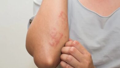 بیماری سلیاک چیست و چطور آن را بشناسیم؟