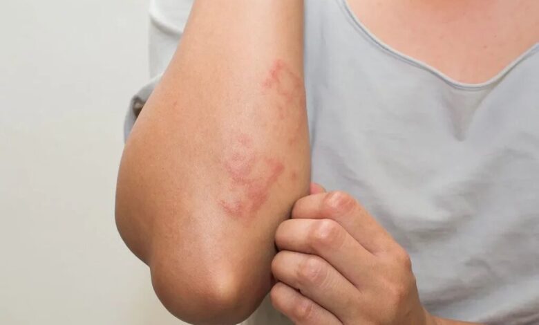 بیماری سلیاک چیست و چطور آن را بشناسیم؟