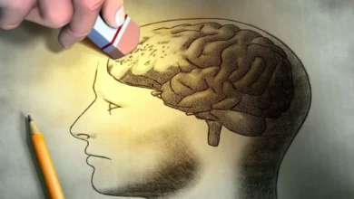 آلزایمر