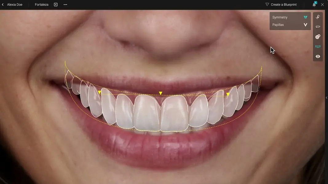 طراحی لبخند با روش های دیجیتال؛ مقایسه ونیر کامپوزیت و لمینت سرامیکی